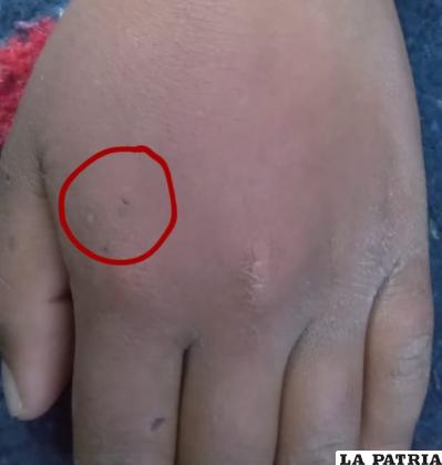 Niño se hizo picar por una viuda negra en la mano /SEDES 