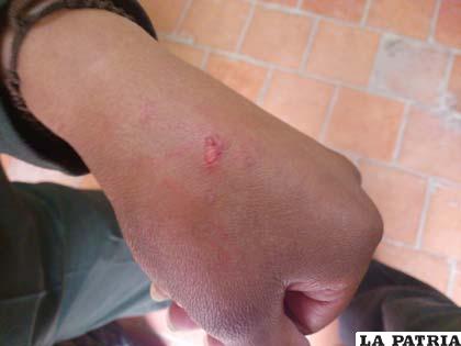 Herida en una de manos de la funcionaria policial agredida