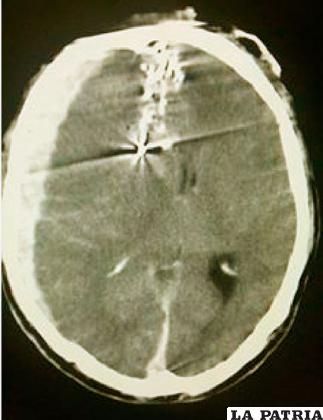 En la fotografía se observa la tomografía y el proyectil alojado en la cabeza del minero