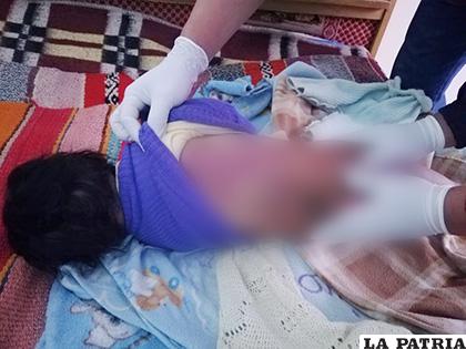 El bebé presentaba cianosis distal debido a la falta de oxígeno /LA PATRIA