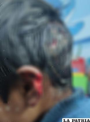 Niño perdió tejido de la oreja derecha /SEDES