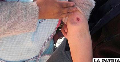 Una mujer muestra la herida de balín que recibió durante los enfrentamientos en Viloco /eldeber.com.bo