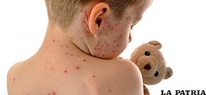 La varicela es una enfermedad infantil benigna que se suele dar entre primavera y verano /medicinatv.com