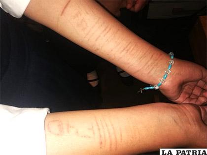 Los cortes en el brazo de una estudiante / LA PATRIA