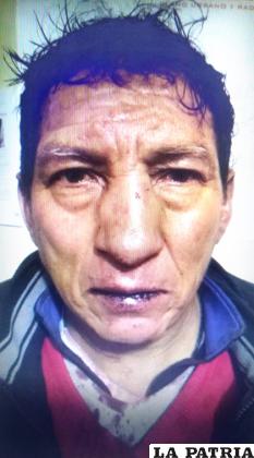 La víctima de 62 años presenta heridas en el rostro por las agresiones que sufrió /LA PATRIA