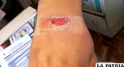 Paciente presentó una erupción cutánea en la mano derecha /SEDES
