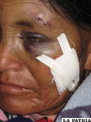 Huellas de la golpiza en el rostro de la madre