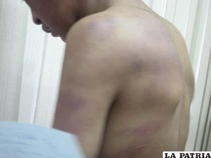 Cuerpo del menor con moretones