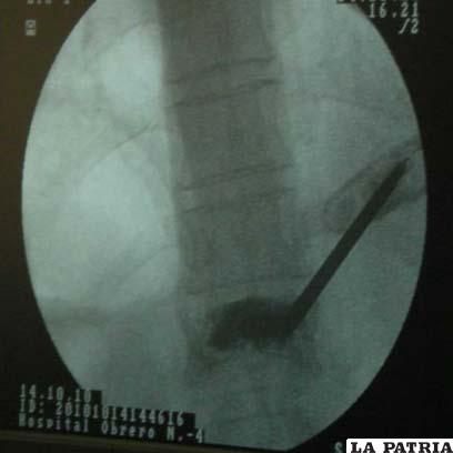 Vertebroplastia, cirugía mínimamente invasiva para fracturas de columna