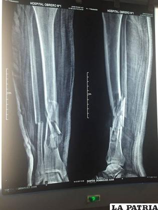Un médico quedó con las piernas fracturadas tal como refleja la radiografía