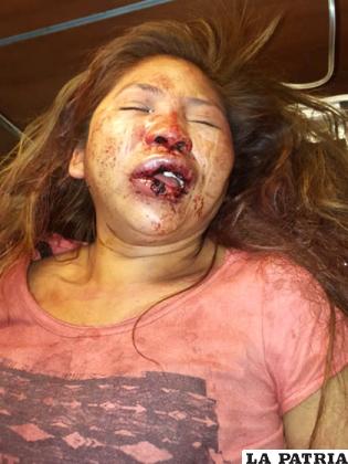La victima presentó serias lesiones en el rostro, la nariz y la dentadura 
/LA PATRIA
