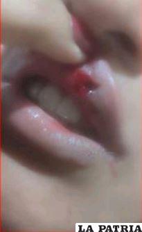  La joven sufrió lesiones en su labio tras ser golpeada por el taxista /Unitel